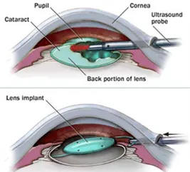 Cataracts 1